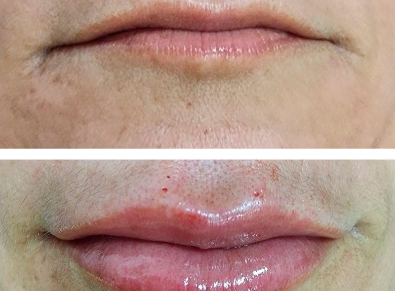 Antes E Depois Preenchimento Labial Cl Nica Rasc Itanhomi