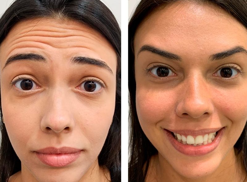 Antes e Depois: Botox 08/05/2023 – Clínica Rasc | Itanhomi